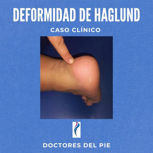 DEFORMIDAD DE HAGLUND - CASO CLNICO