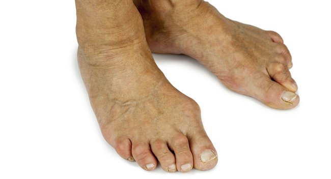 CIRUGÍA DE JUANETES (HALLUX VALGUS) Y DEDOS EN MARTILLO