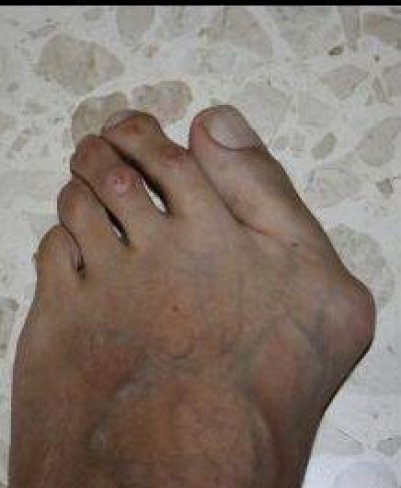 CIRUGÍA DE JUANETES (HALLUX VALGUS)