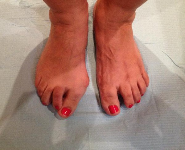 CIRUGÍA DE JUANETES (HALLUX VALGUS)