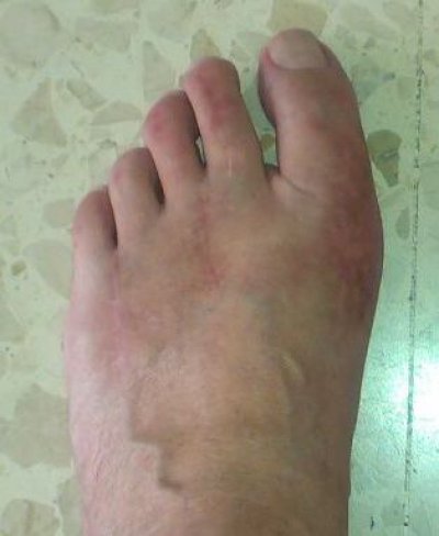 CIRUGÍA DE JUANETES (HALLUX VALGUS)