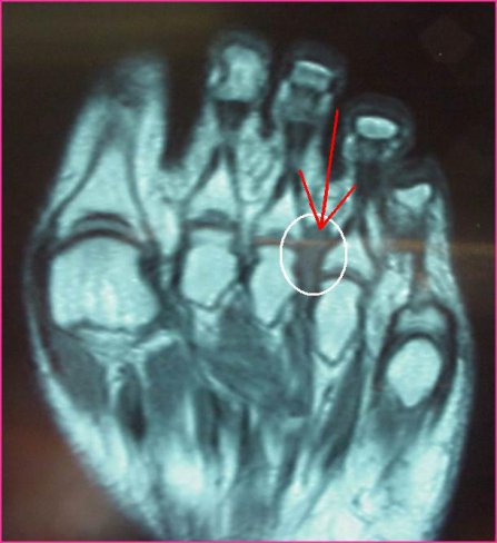 CIRUGÍA DE NEUROMA DE MORTON