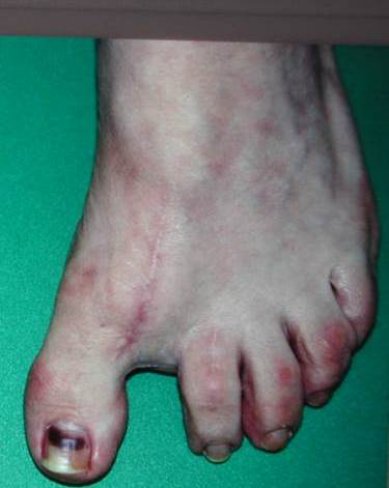 CIRUGÍA DE HALLUX VARUS