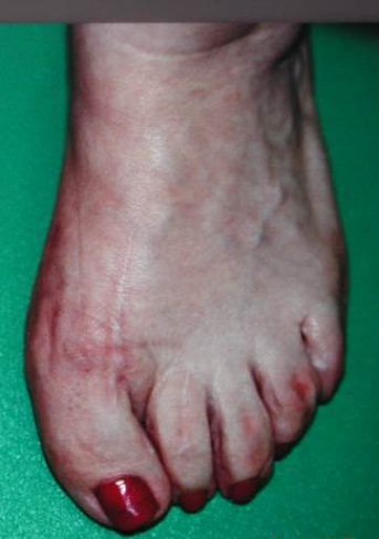 CIRUGÍA DE HALLUX VARUS