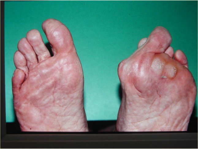 CIRUGÍA DE JUANETES (HALLUX VALGUS)