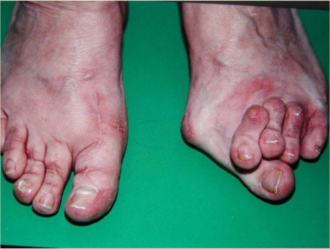 CIRUGÍA DE JUANETES (HALLUX VALGUS)