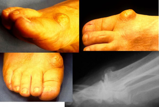 CIRUGA DE HALLUX RIGIDUS