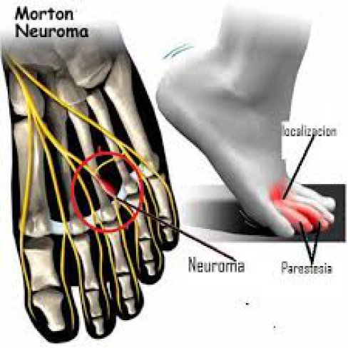 CIRUGÍA DE NEUROMA DE MORTON