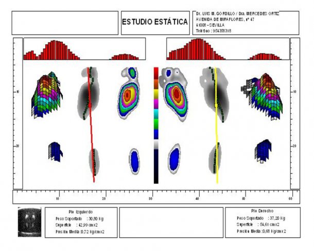 PIERNAS ARQUEADAS O EN "FORMA DE PARÉNTESIS"