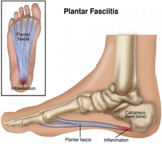 CIRUGÍA PARA FASCITIS PLANTAR