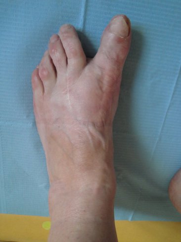 HALLUX VARUS