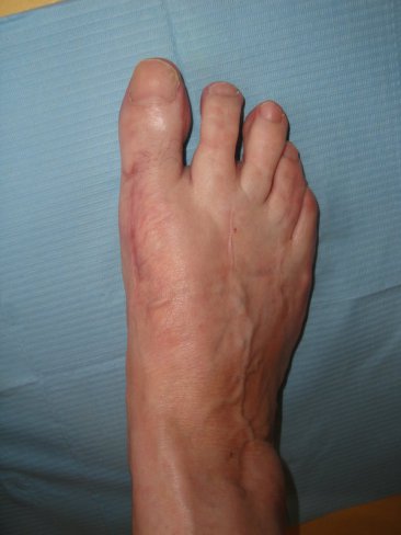 HALLUX VARUS