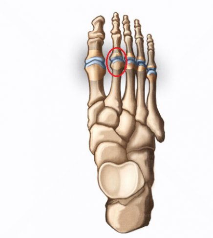 CAPSULITIS DE LA ARTICULACIÓN METATARSOFALÁNGICA