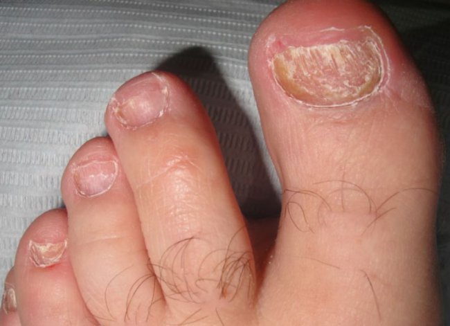 ¿CÓMO ELIMINAR LOS HONGOS DE LAS UÑAS DE LOS PIES?