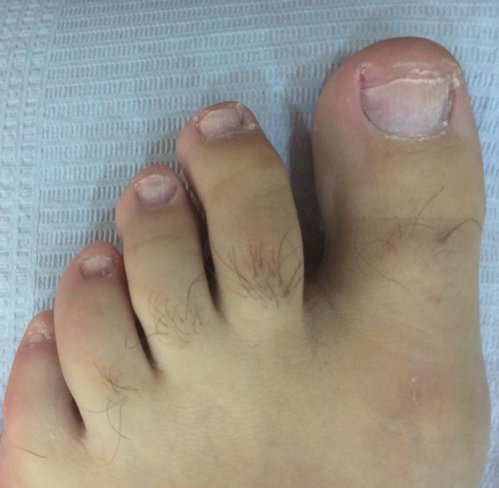 ¿CÓMO ELIMINAR LOS HONGOS DE LAS UÑAS DE LOS PIES?