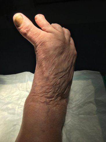 ITERVENCIN QUIRRGICA DE HALLUX VARUS EN EL HOSPITAL VIAMED SANTA ANGELA