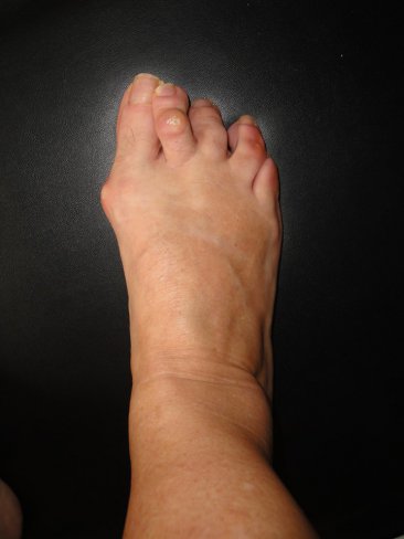 CIRUGÍA DE JUANETES (HALLUX VALGUS)