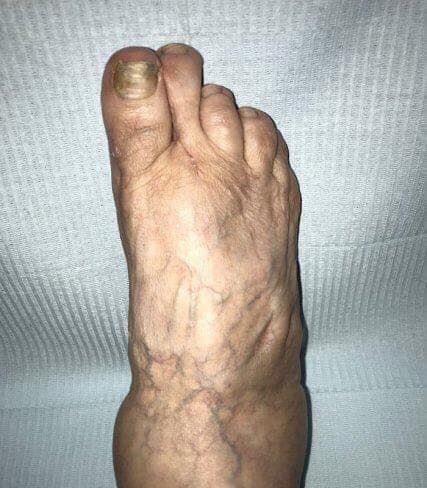 CIRUGÍA DE HALLUX VARUS IATROGÉNICO