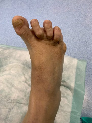 CIRUGÍA DE HALLUX VARUS