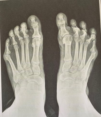 CIRUGÍA DE HALLUX VARUS