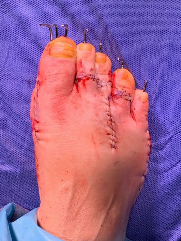 CIRUGÍA DE HALLUX VARUS