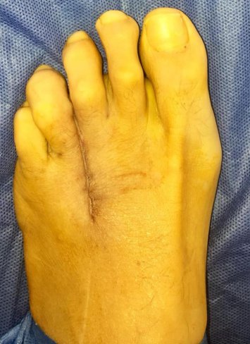 CIRUGÍA DE NEUROMA DE MORTON