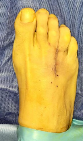 CIRUGÍA DE NEUROMA DE MORTON