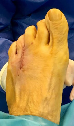 CIRUGÍA DE NEUROMA DE MORTON