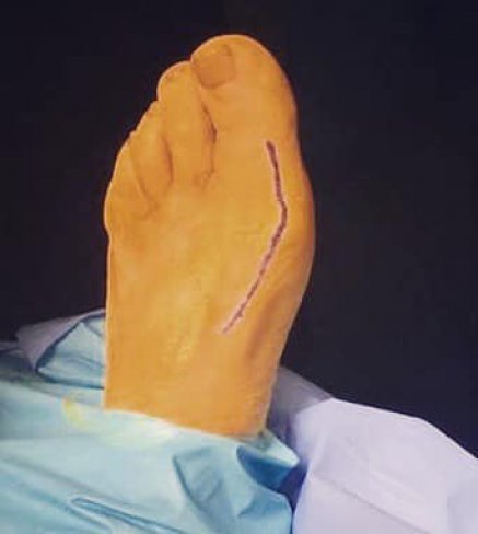 CIRUGÍA DE HALLUX LIMITUS