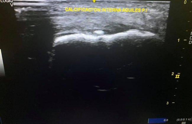 AQUILEITIS INSERCIONAL EN DEPORTISTA