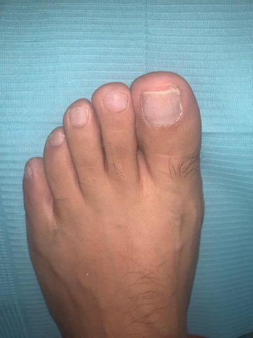 ¿CÓMO ELIMINAR LOS HONGOS DE LAS UÑAS DE LOS PIES?