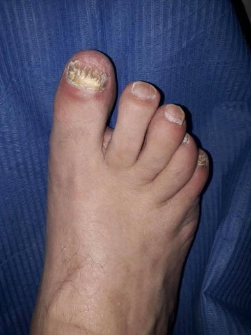 ¿CÓMO ELIMINAR LOS HONGOS DE LAS UÑAS DE LOS PIES?