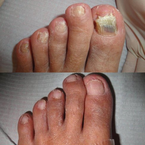 ¿CÓMO ELIMINAR LOS HONGOS DE LAS UÑAS DE LOS PIES?