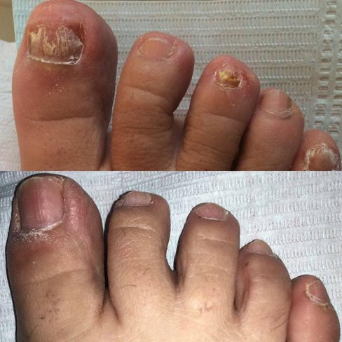 ¿CÓMO ELIMINAR LOS HONGOS DE LAS UÑAS DE LOS PIES?