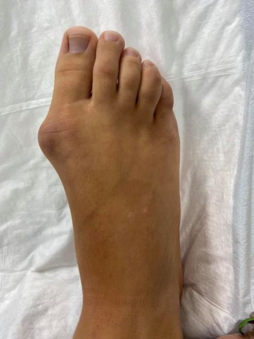 CIRUGÍA DE JUANETES (HALLUX VALGUS)