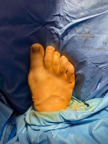 CIRUGÍA DE JUANETES (HALLUX VALGUS)