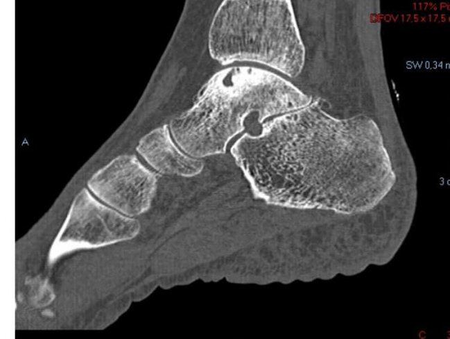 OSTEOCONDRITIS DE ASTRÁGALO