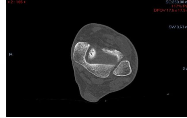 OSTEOCONDRITIS DE ASTRÁGALO