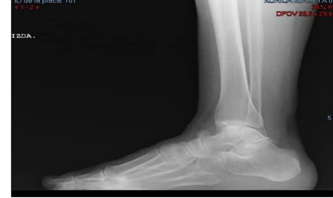 OSTEOCONDRITIS DE ASTRÁGALO