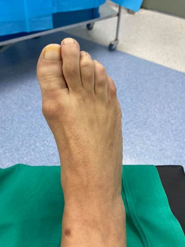 CIRUGA DE HALLUX LIMITUS/RIGIDUS