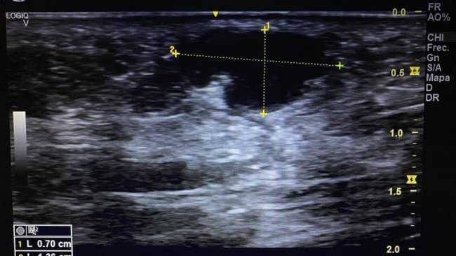 ROTURA DE FASCICULOS DE LA FASCIA