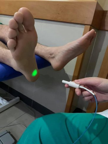 CIRUGÍA PARA FASCITIS PLANTAR