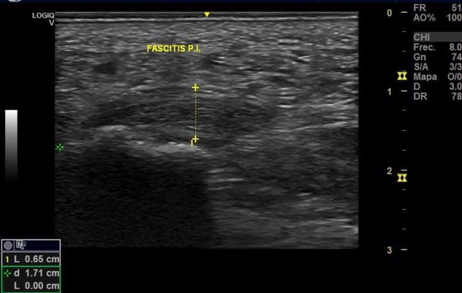 CIRUGÍA PARA FASCITIS PLANTAR