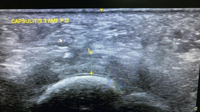 CAPSULITIS DE LAS ARTICULACIONES METATARSOFALÁNGICAS