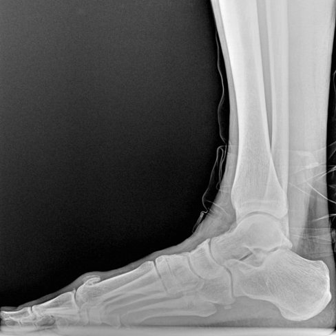 HALLUX RIGIDUS