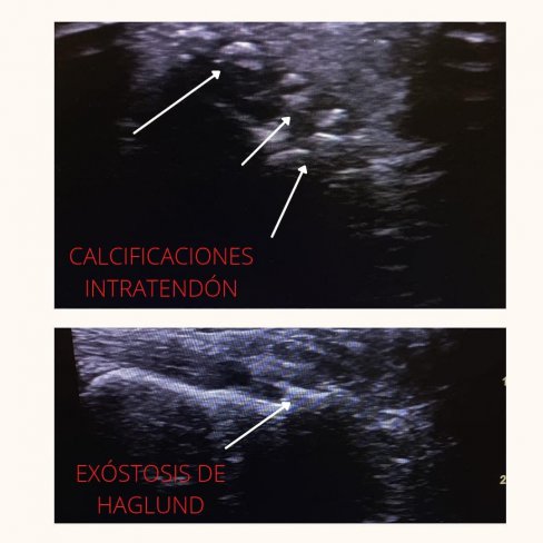 CALCIFICACIONES INTRATENDÓN DE TENDÓN DE AQUILES