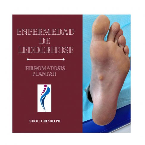 ENFERMEDAD DE LEDDERHOSE O FIBROMATOSIS PLANTAR 