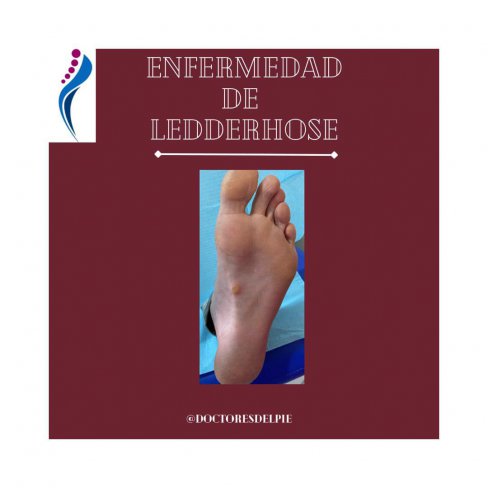 ENFERMEDAD DE LEDDERHOSE O FIBROMATOSIS PLANTAR 