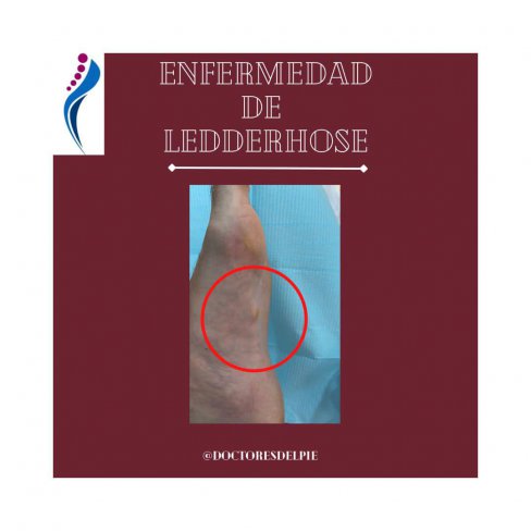 ENFERMEDAD DE LEDDERHOSE O FIBROMATOSIS PLANTAR 