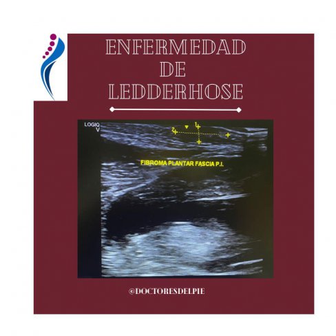 ENFERMEDAD DE LEDDERHOSE O FIBROMATOSIS PLANTAR 